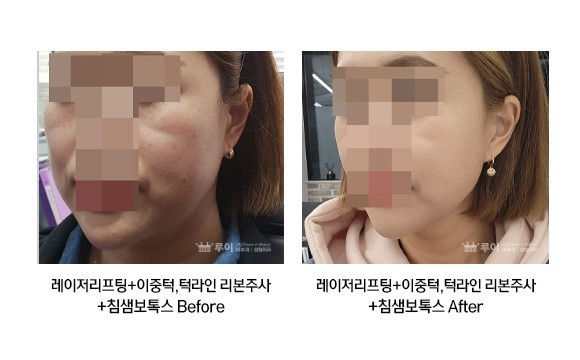 레이저리프팅+이중턱 리본+턱라인 리본주사+침샘보톡스