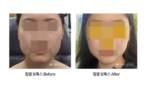 심부볼/이중턱 리본주사+침샘보톡스