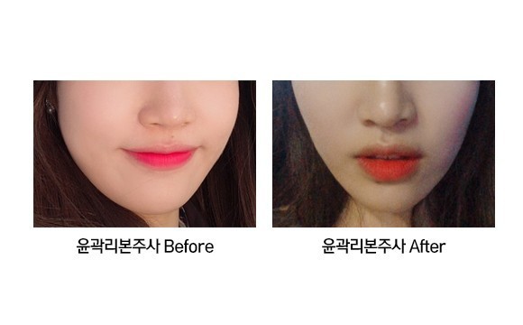 윤곽리본주사
