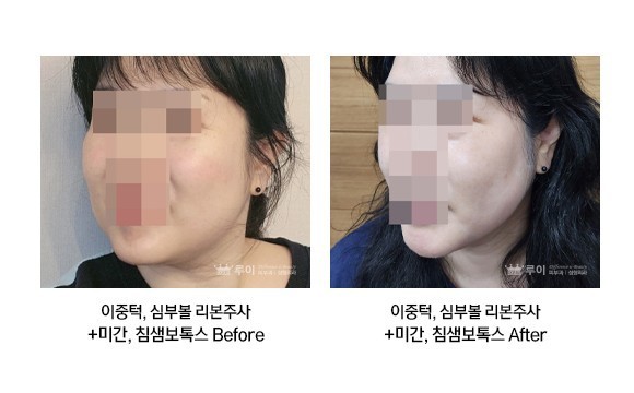 이중턱 리본주사,심부볼 리본주사,미간 보톡스,침샘보톡스