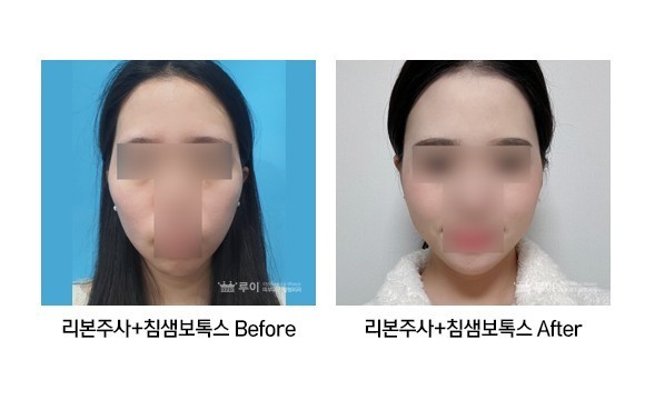 광대리본주사+라인보톡스