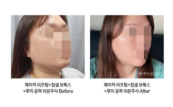 레이저 리프팅+리본주사+침샘보톡스