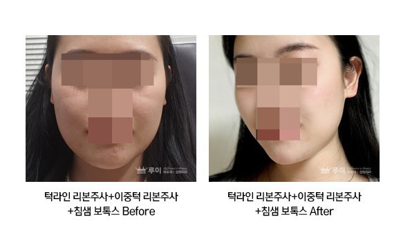 이중턱 리본주사+침샘보톡스