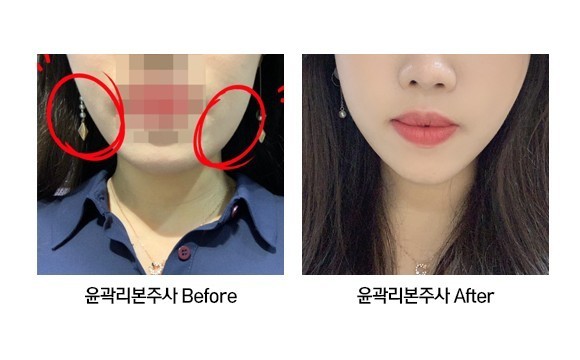 윤곽리본주사