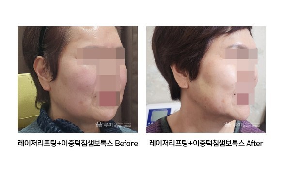 레이저리프팅,이중턱 침샘리본톡스