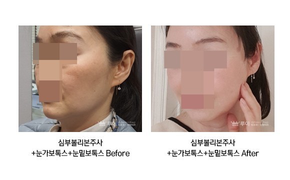 심부볼 리본주사+눈가/눈밑보톡스