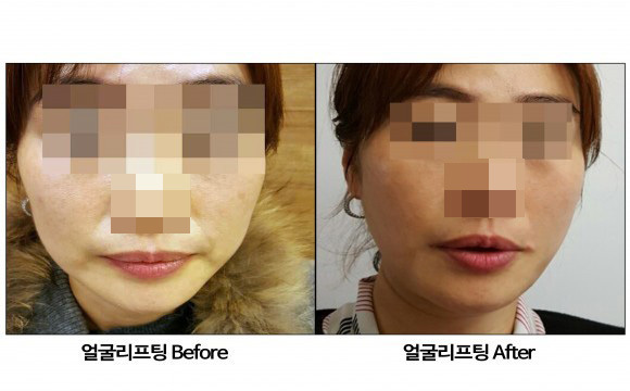 얼굴리프팅 전 후 