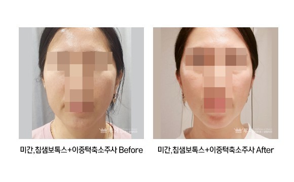 미간 보톡스+이중턱 축소주사,침샘보톡스