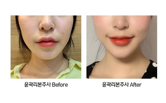 윤곽리본주사