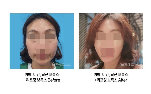 풀 페이스 보톡스+ 리프팅 보톡스