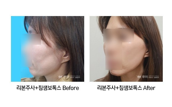 레이저리프팅+이중턱 리본+턱라인 리본주사+침샘보톡스