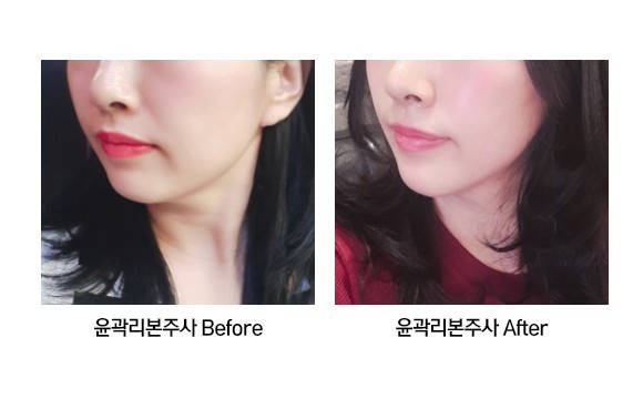 윤곽리본주사